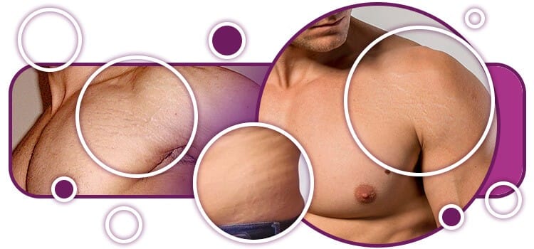 Estrias na adolescência: é normal, como evitar e o que realmente funciona - Adolescência & Comportamento